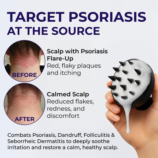Scalp Psoriasis Shampoo Flakes Anti Dandruff Itchy Scalp Treatment For Seborrheic Dermatitis Folliculitis Anti Fungal Medicated Solution For Itchy Flaky Dry Hairs